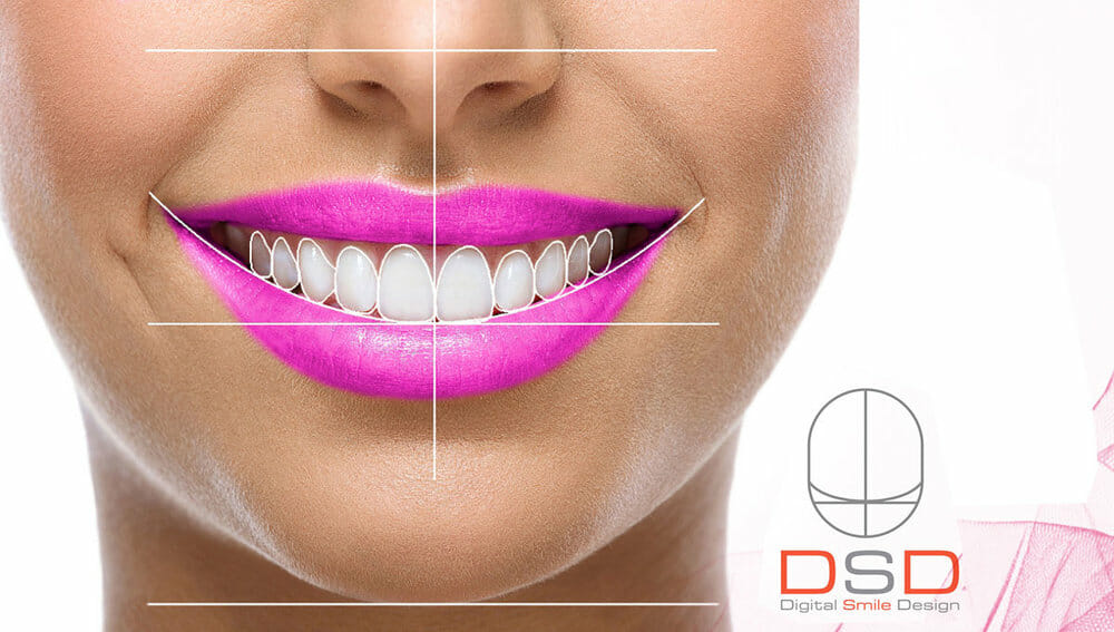 Digital Smile Design