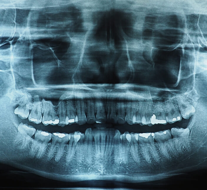 extractions extractions xray
