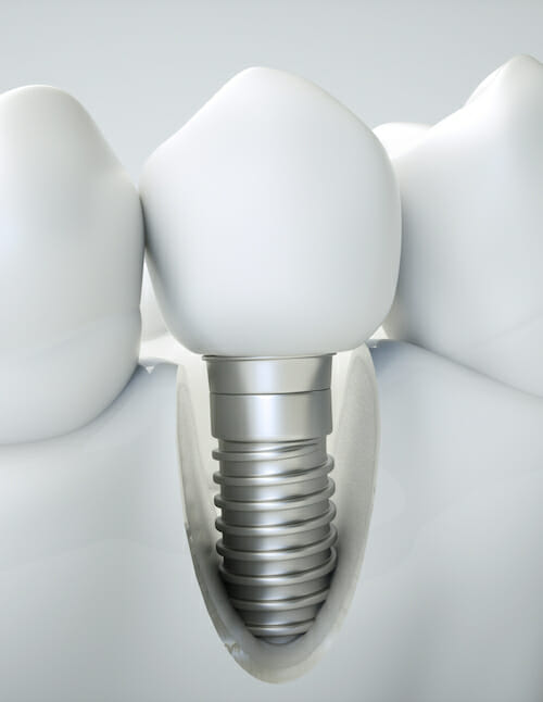 implants dental implant