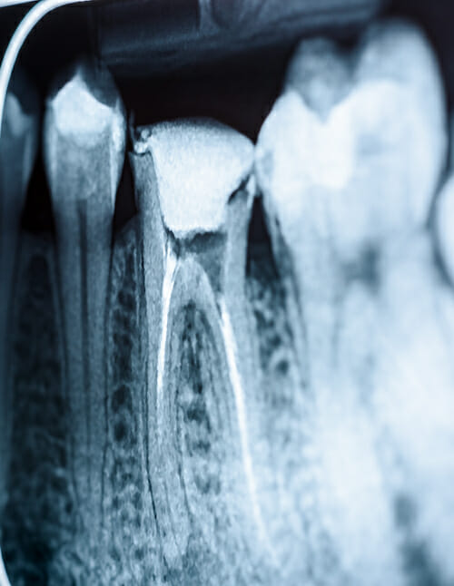 root canal xray