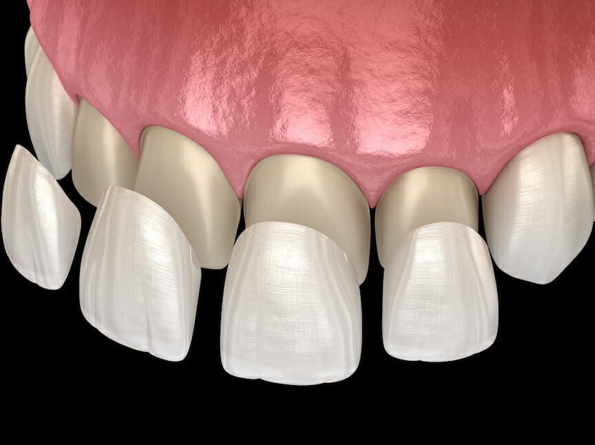 veneers veneers