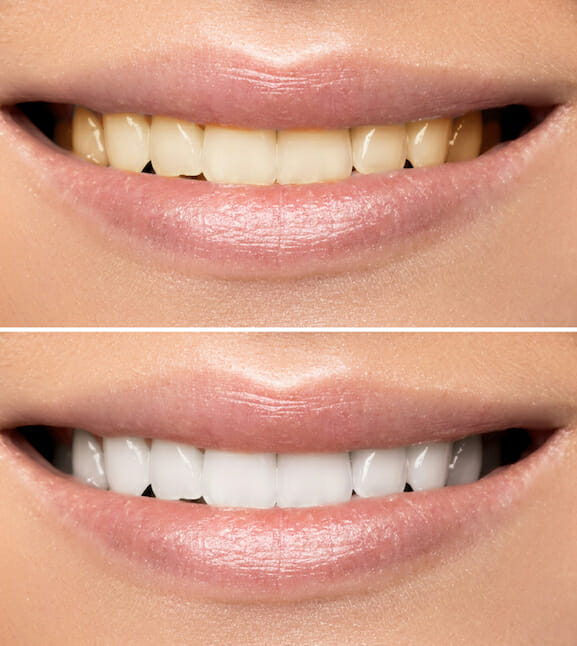 before and after teeth whitening