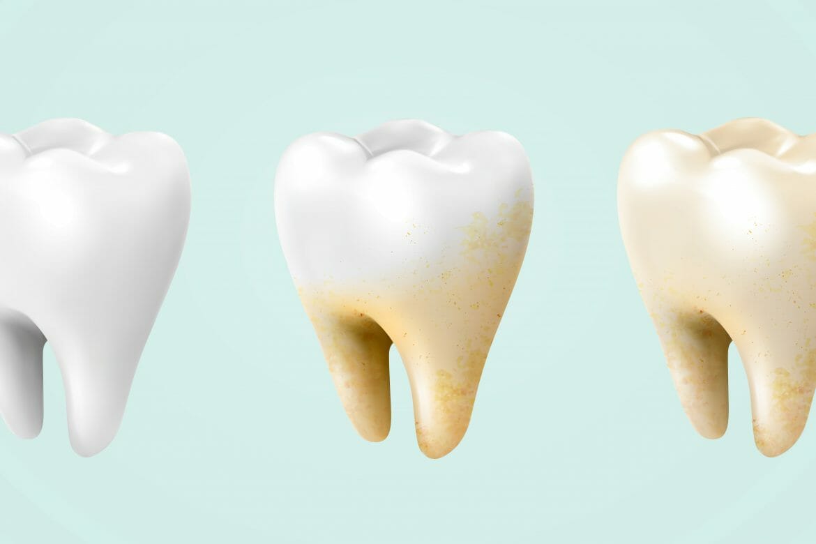 How To Get Rid Of Stains Between My Teeth Yellow Teeth