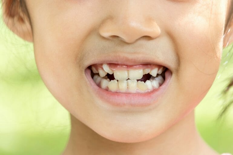 Child With Crooked Teeth