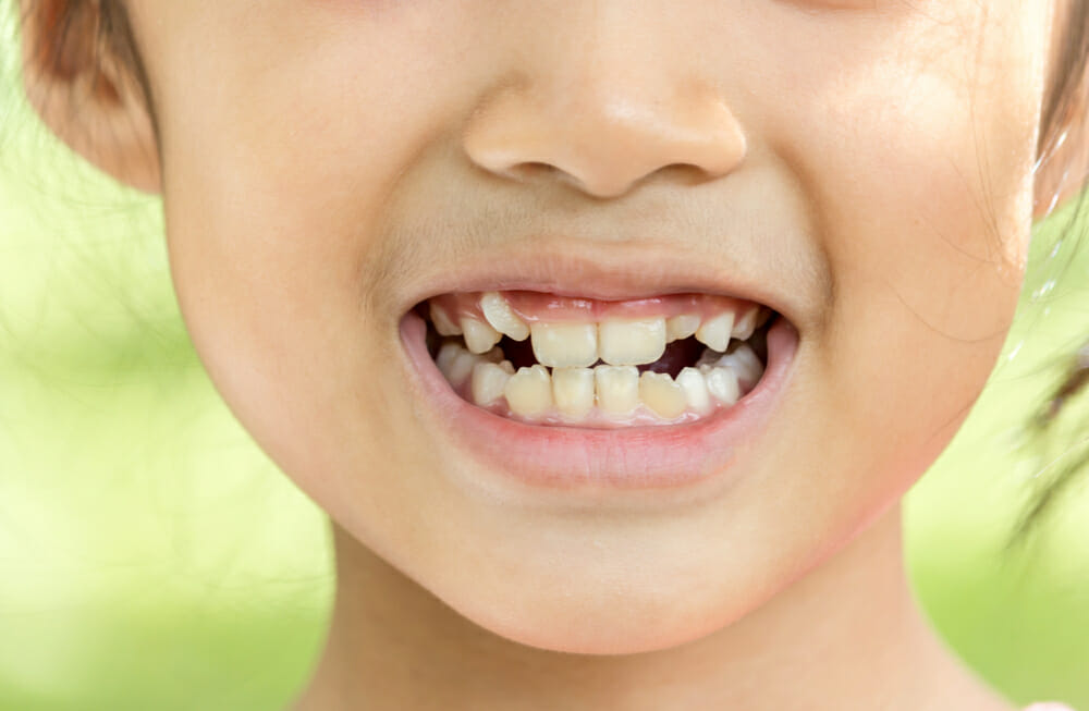 Child With Crooked Teeth