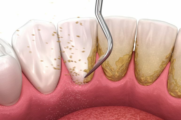 Tool Scraping Plaque Off Teeth