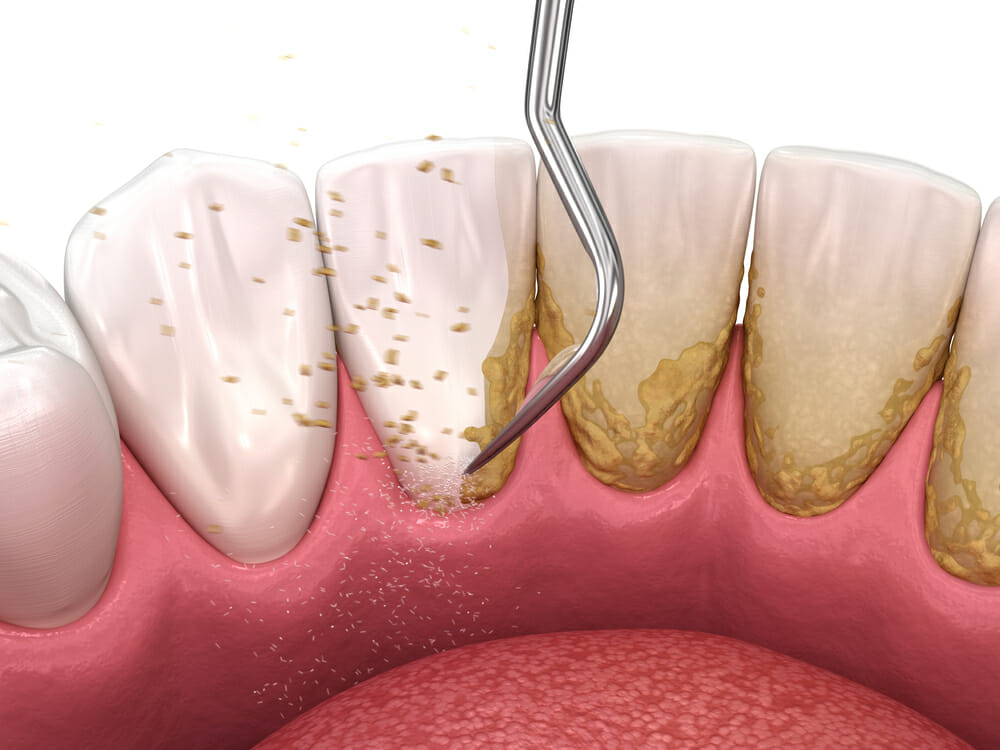 Tool Scraping Plaque Off Teeth