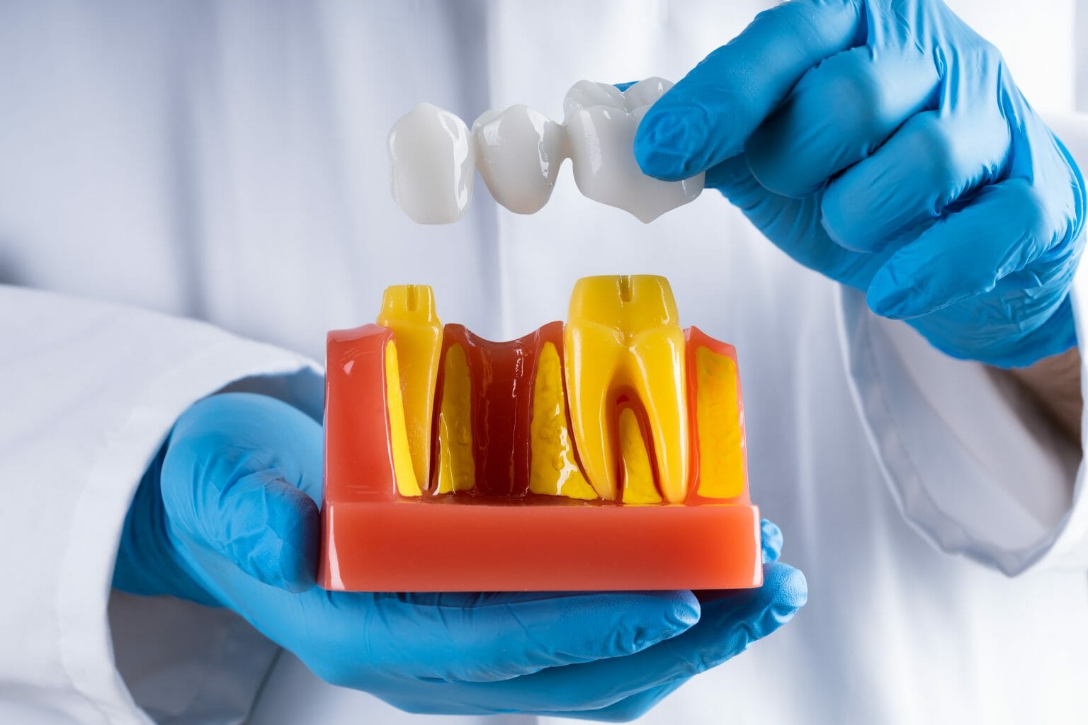 About Dental Bridges