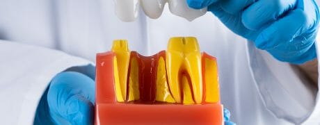 Dental Bridge