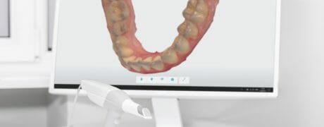 The Difference Between Digital Dental Scanner and Past Impressions Options