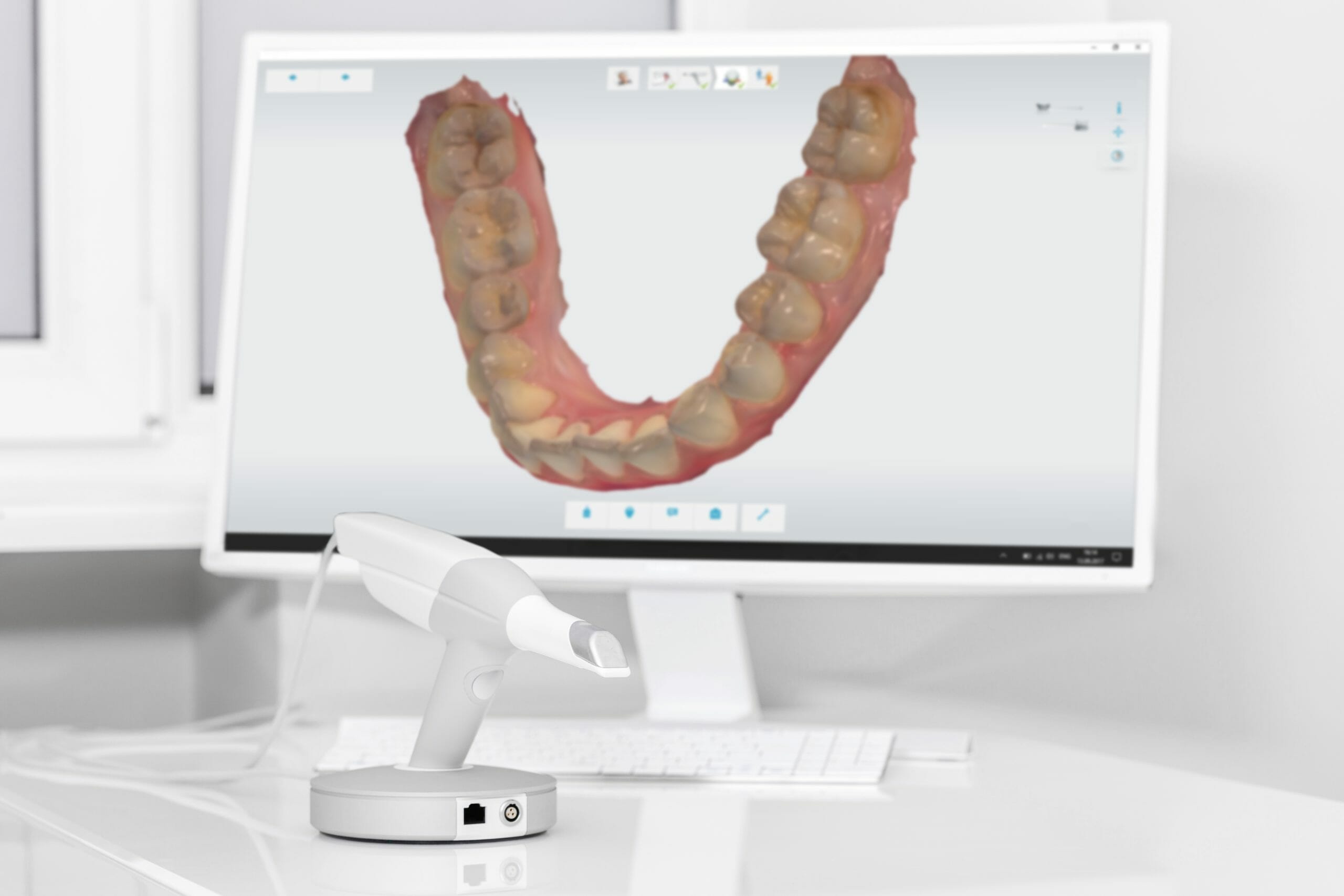 Digital Dental Scanner vs. Past Impressions Options
