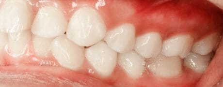 Don't Let Gum Disease Ruin Your Smile