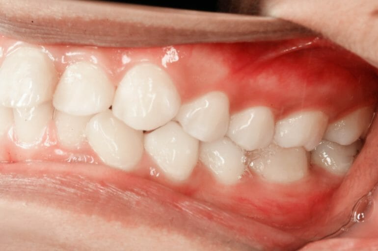 Don't Let Gum Disease Ruin Your Smile