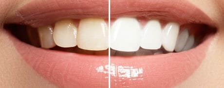 What are the Different Types of Teeth Whitening and How Do They Work?