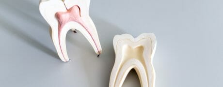 Pros and Cons of Root Canal Therapy