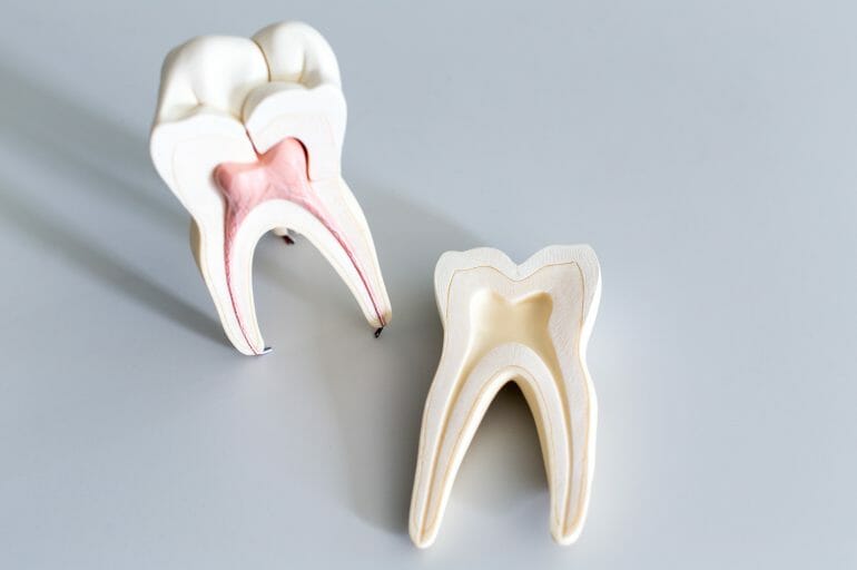 Pros and Cons of Root Canal Therapy
