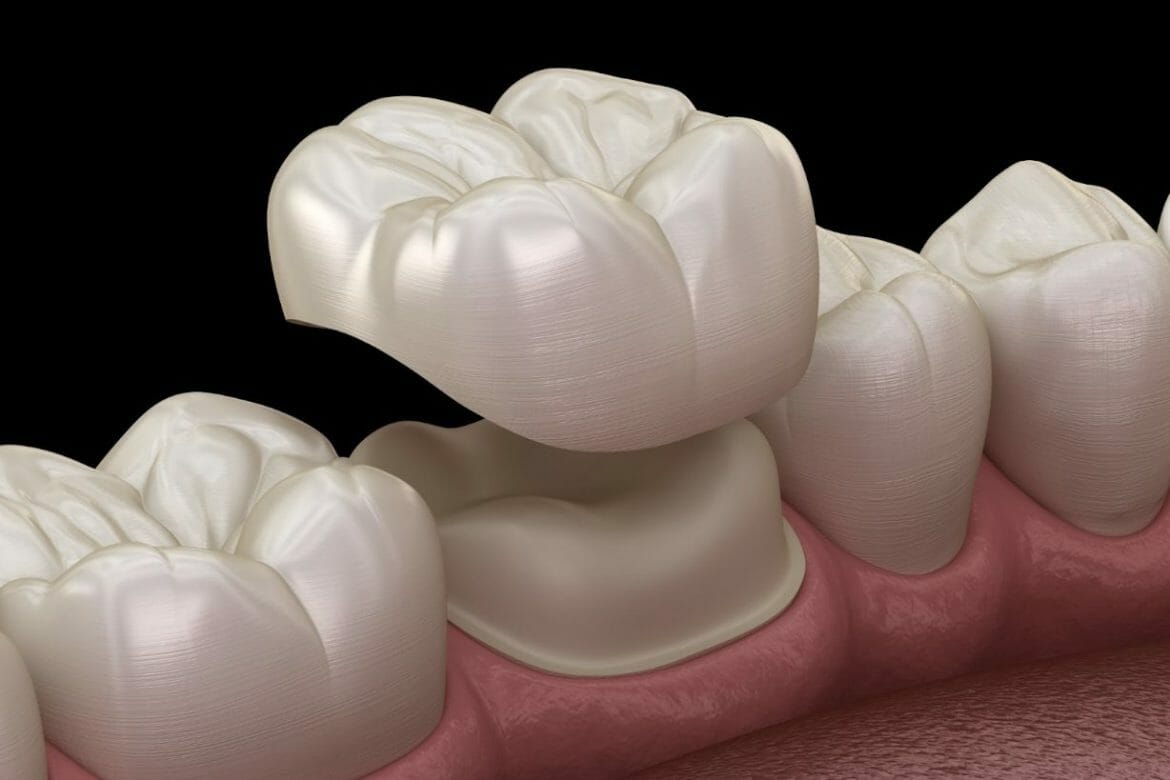 With Dental Crowns, You Can Restore Your Teeth!