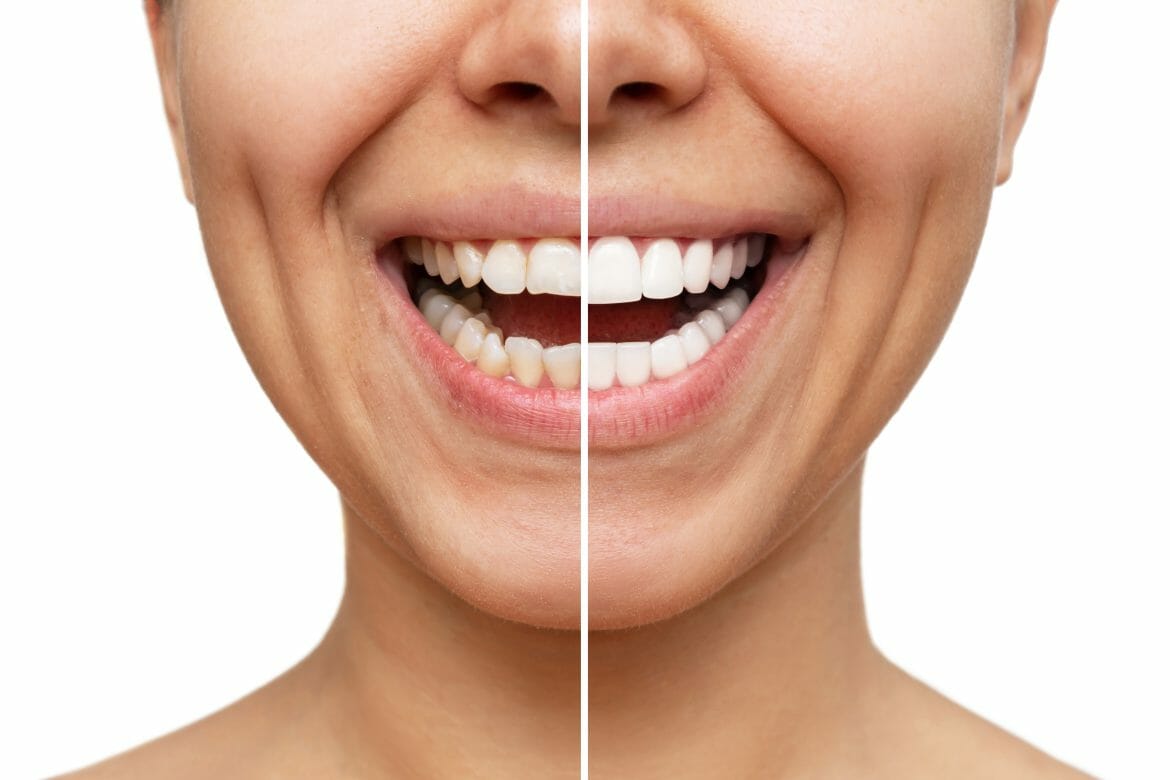 comparison of veneers to normal teeth