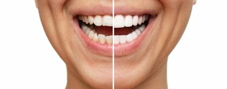 comparison of veneers to normal teeth