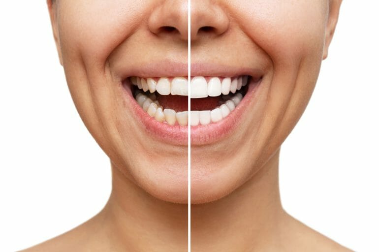 comparison of veneers to normal teeth