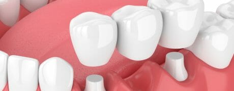 dental bridge diagram