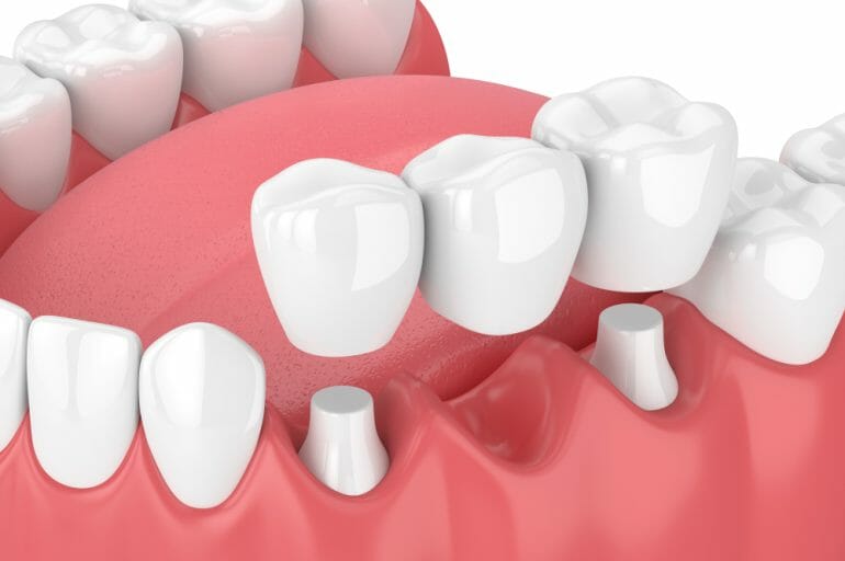 dental bridge diagram