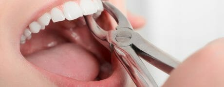 tooth extraction